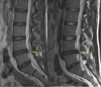 Hernia discal