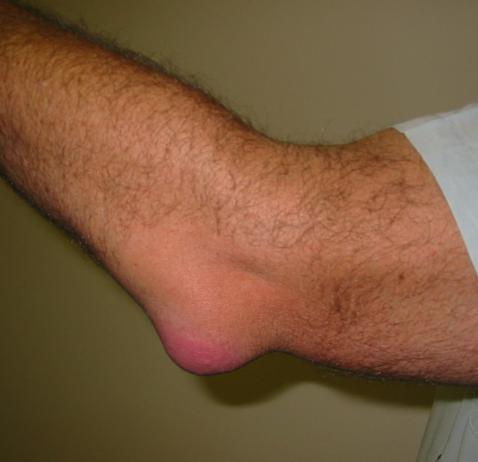 Bursitis Olecranon