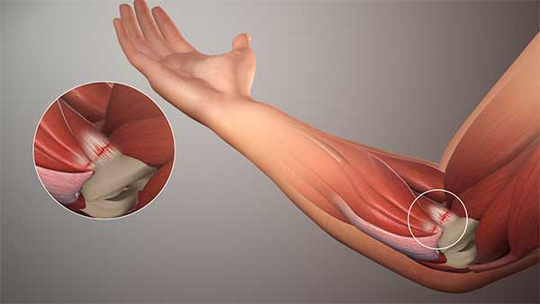 epicondilitis medial