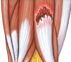 DESGARROS Y LESIONES MUSCULARES