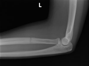 FRACTURAS POR ESTRES