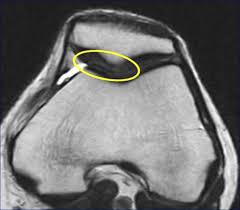 PATELOFEMORAL